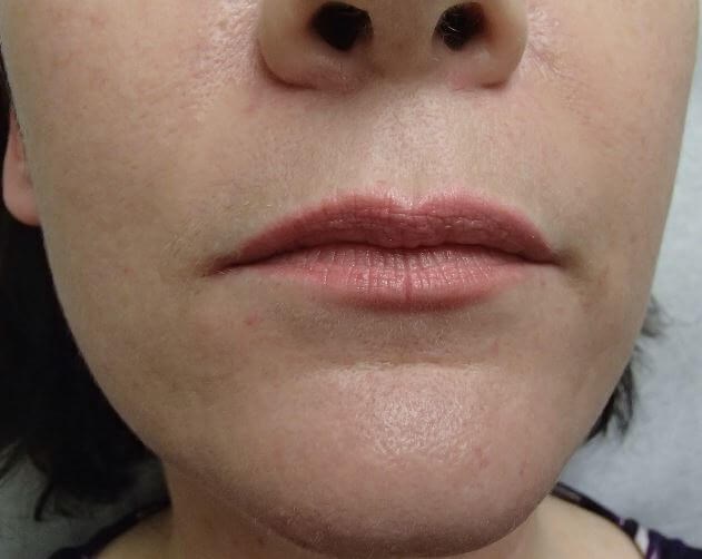 Juvederm Before