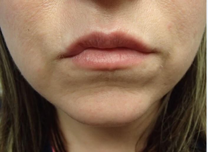 Juvederm After