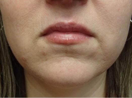 Juvederm Before