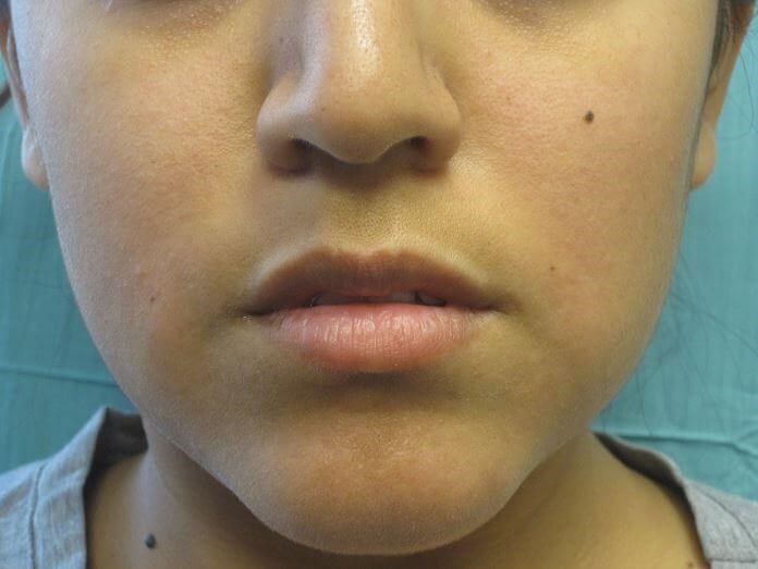 Juvederm Before
