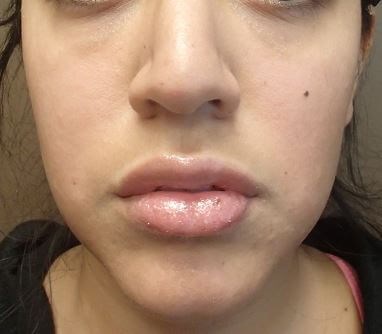 Juvederm After
