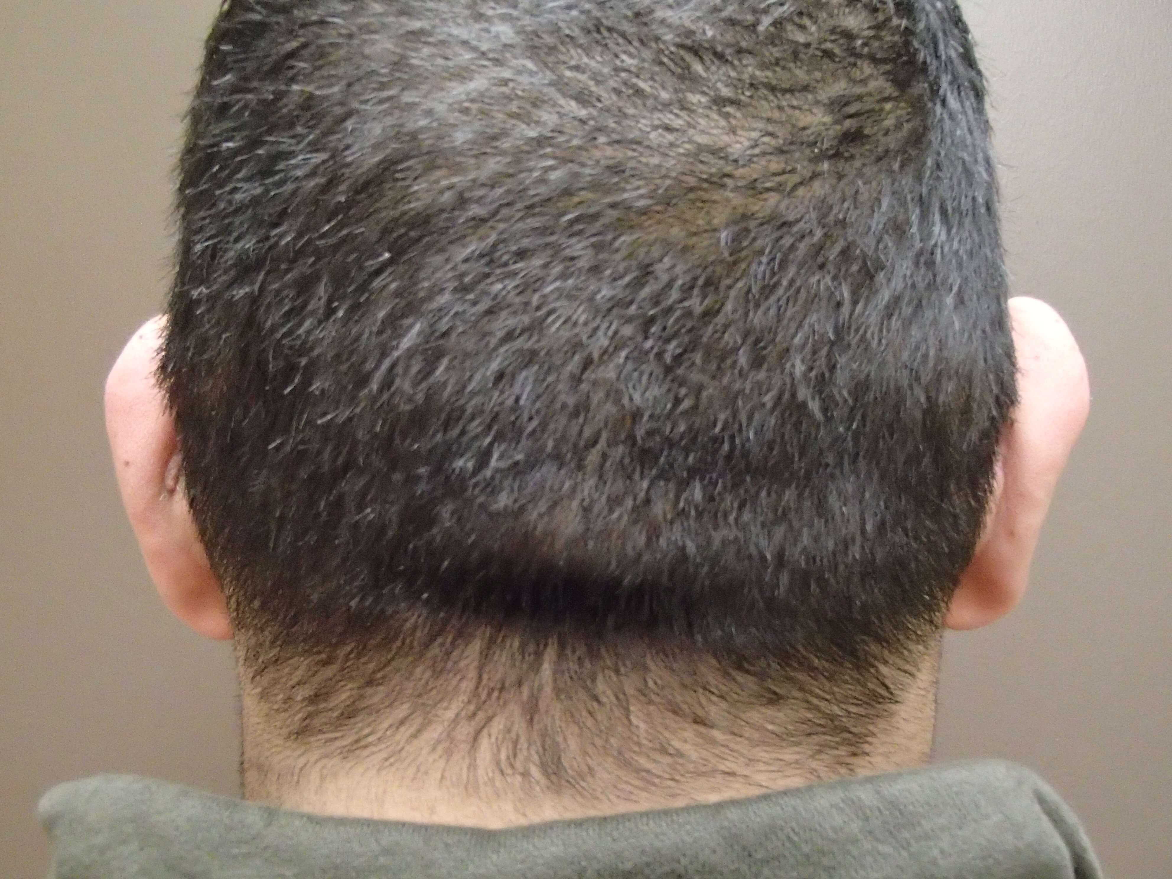 Otoplasty After