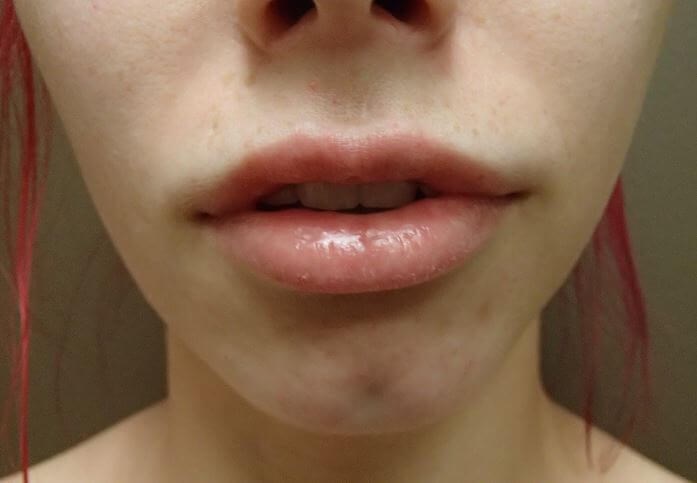 Juvederm After