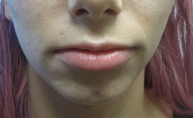 Juvederm Before
