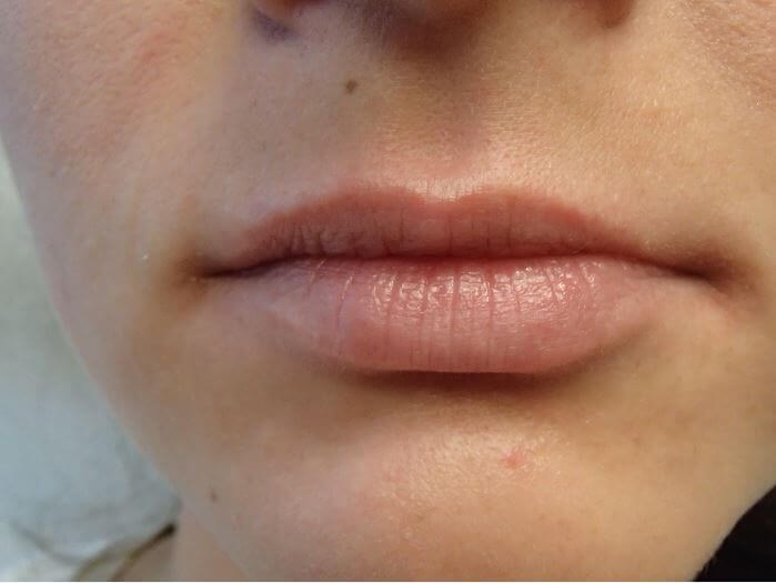 Juvederm Before