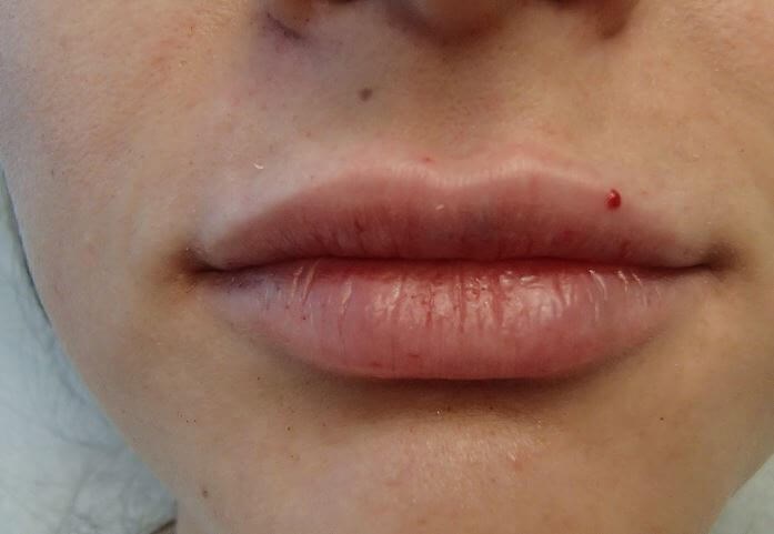 Juvederm After