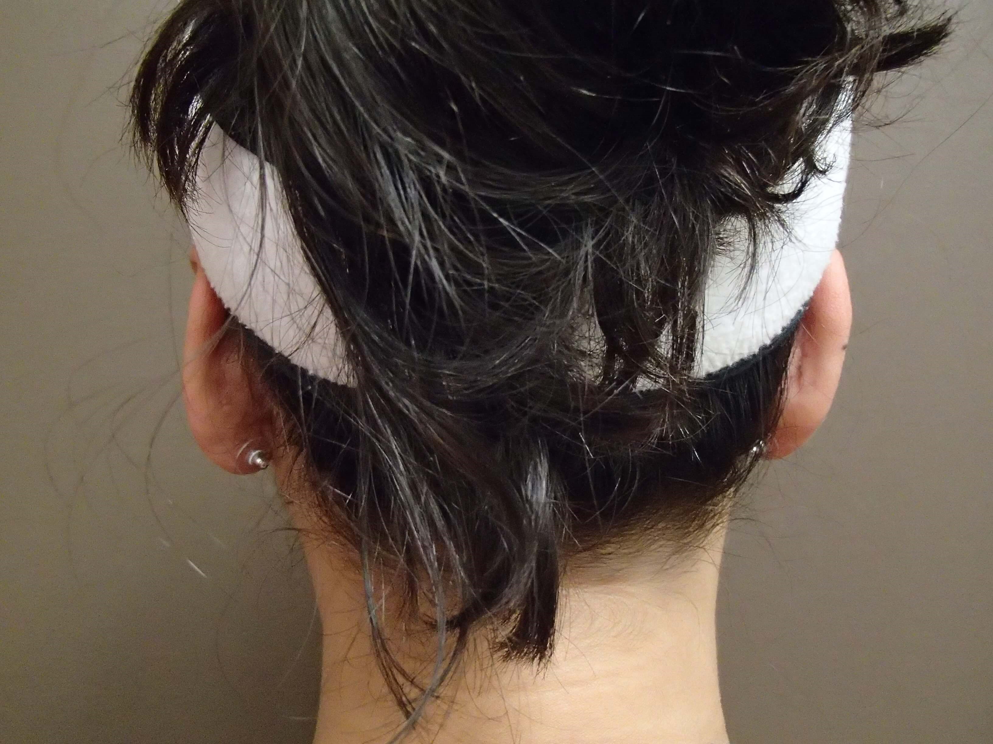 Otoplasty After