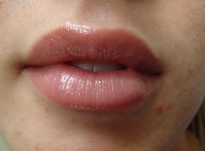 Juvederm After