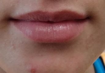 Juvederm Before