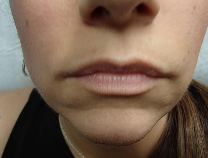 Juvederm Before