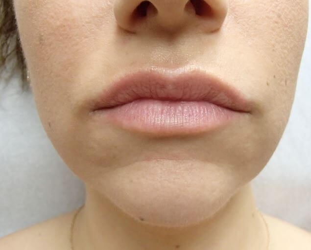 Juvederm After