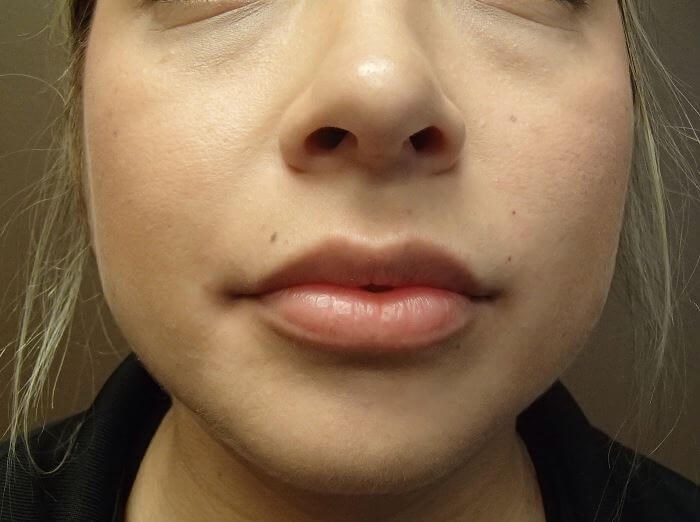 Juvederm After