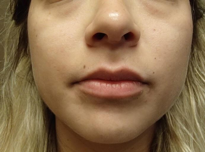 Juvederm Before