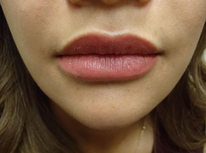 Juvederm After