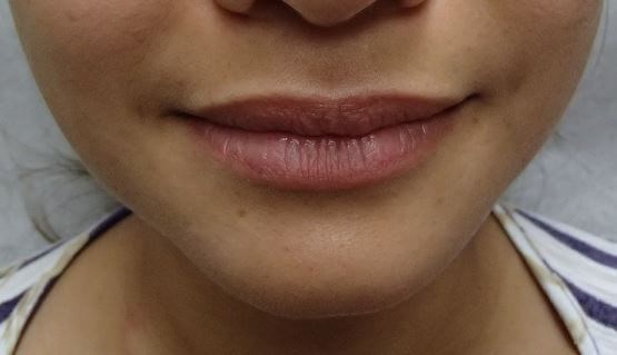 Juvederm Before