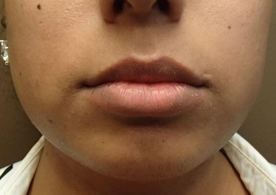Juvederm Before