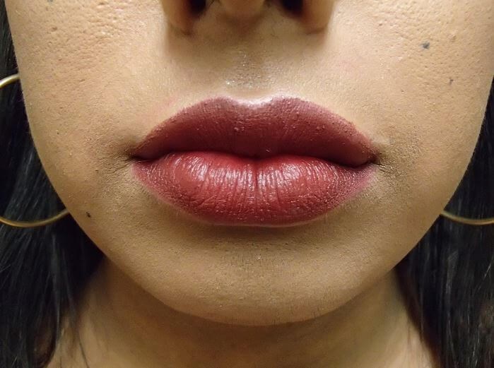 Juvederm After