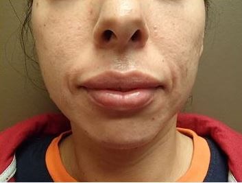 Juvederm After