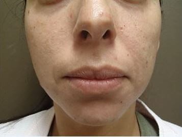 Juvederm Before