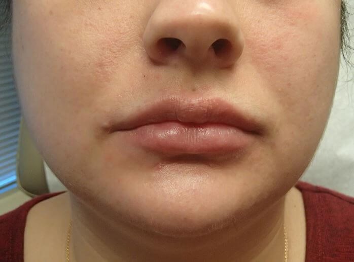 Juvederm After