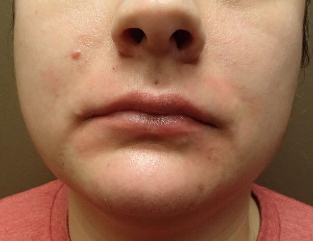 Juvederm Before