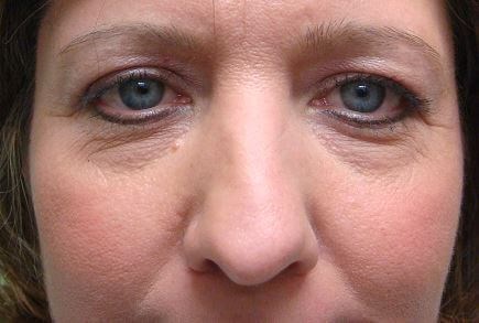 Blepharoplasty Before