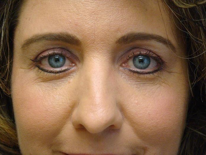 Blepharoplasty After