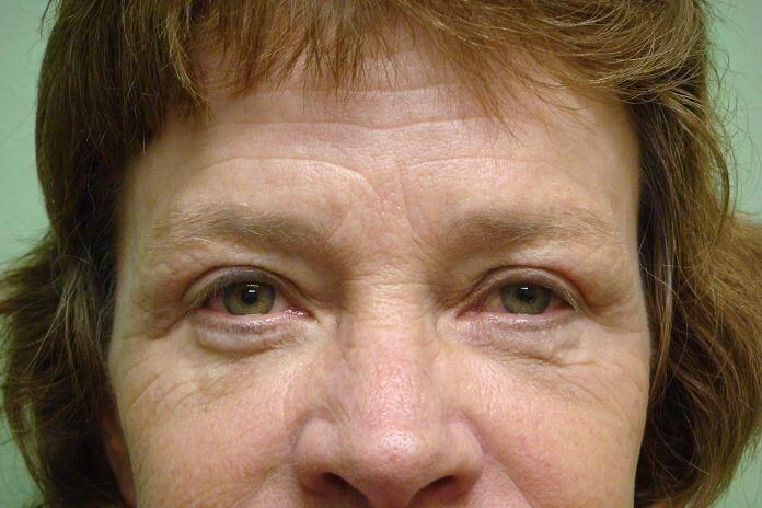 Blepharoplasty After