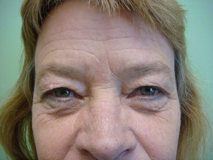Blepharoplasty Before