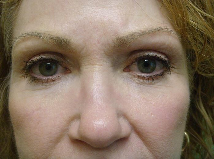 Blepharoplasty Before