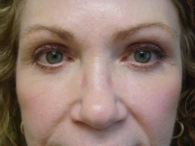 Blepharoplasty After