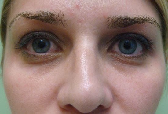 Blepharoplasty Before
