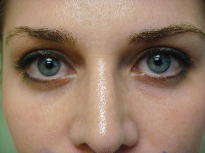 Blepharoplasty After