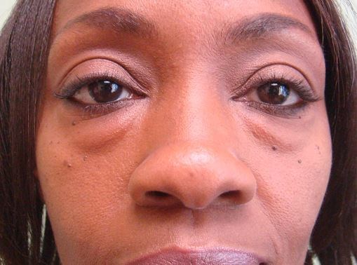 Blepharoplasty Before