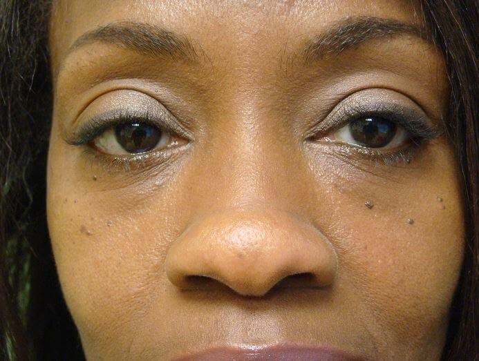 Blepharoplasty After
