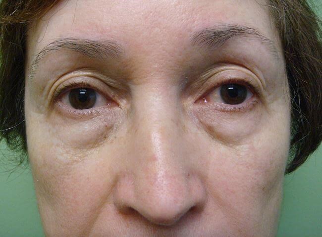 Blepharoplasty Before