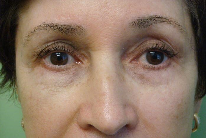 Blepharoplasty After
