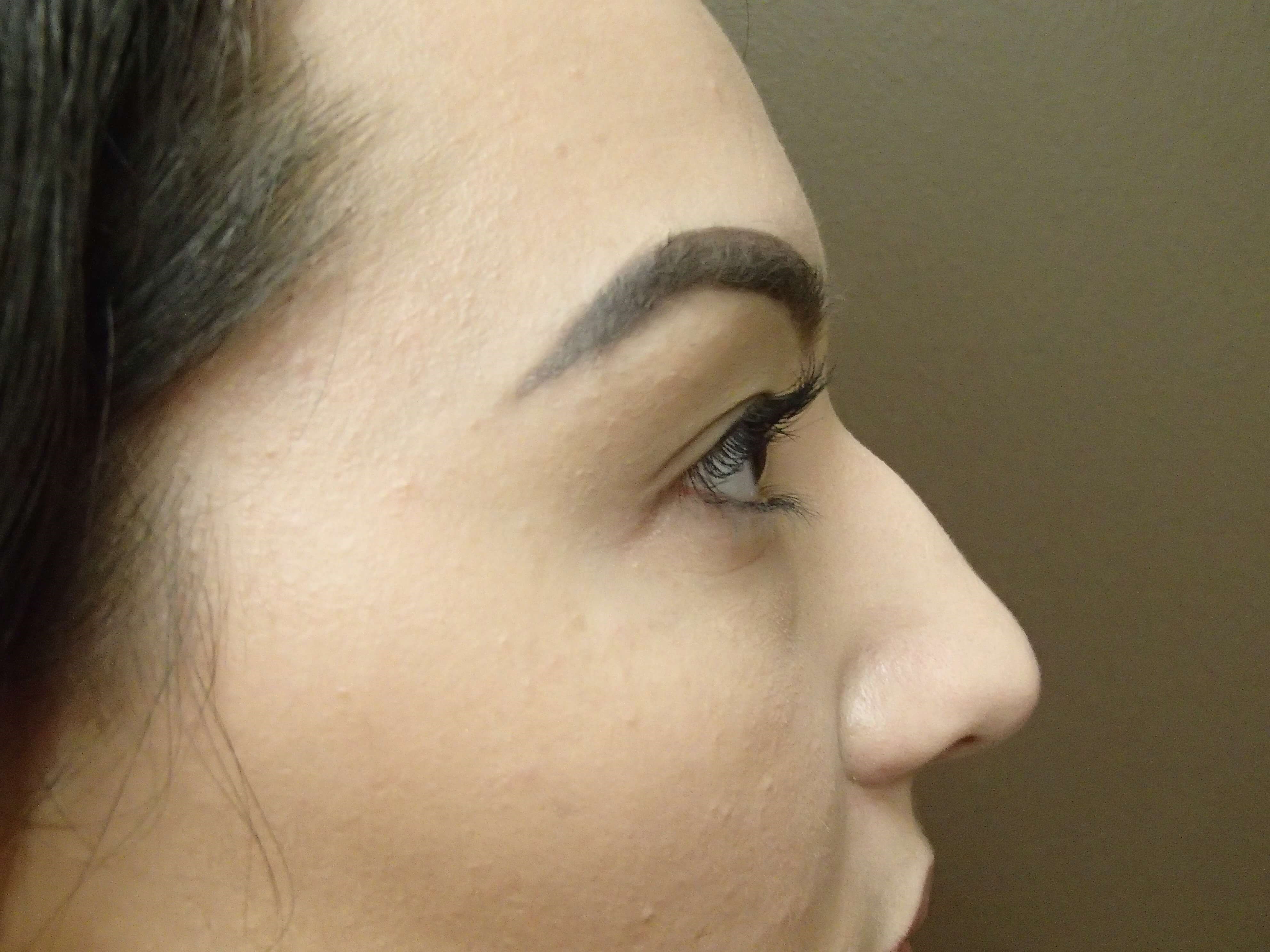 Rhinoplasty (nose job) Before
