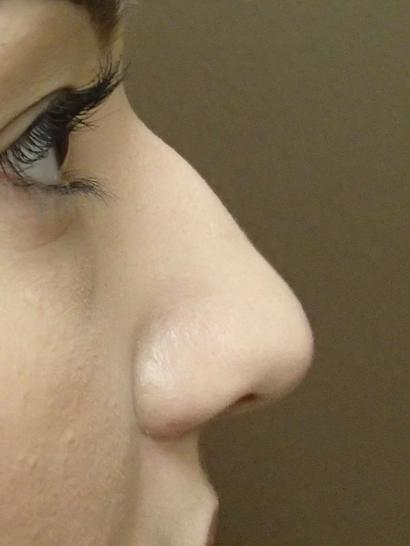 Rhinoplasty (nose job) Before