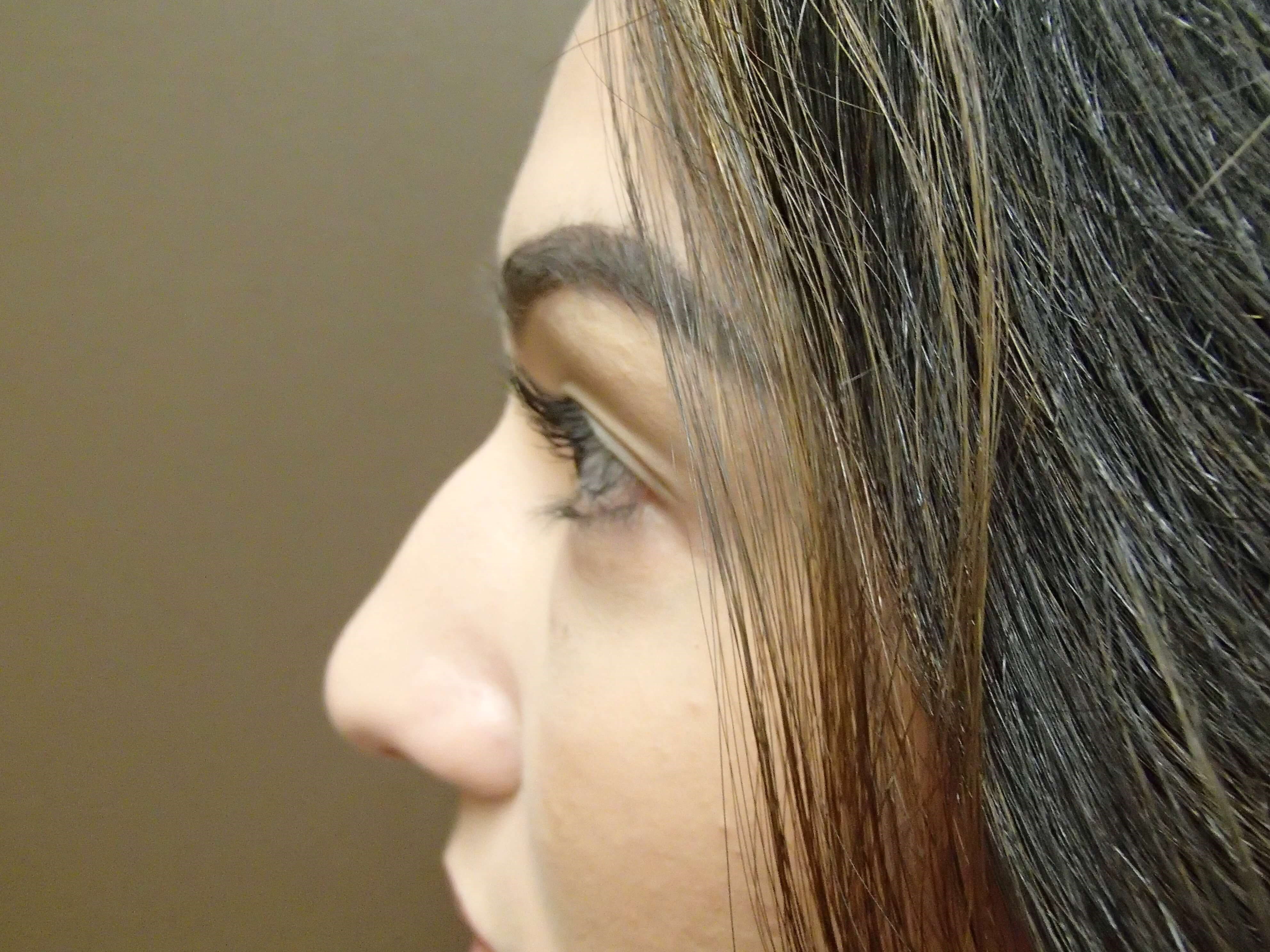Rhinoplasty (nose job) Before