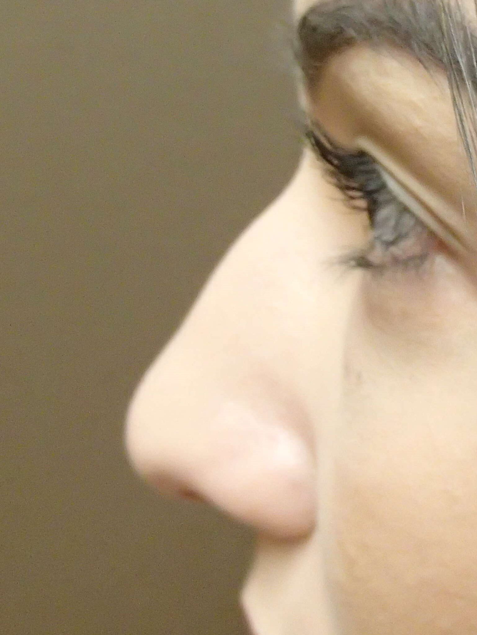 Rhinoplasty (nose job) Before