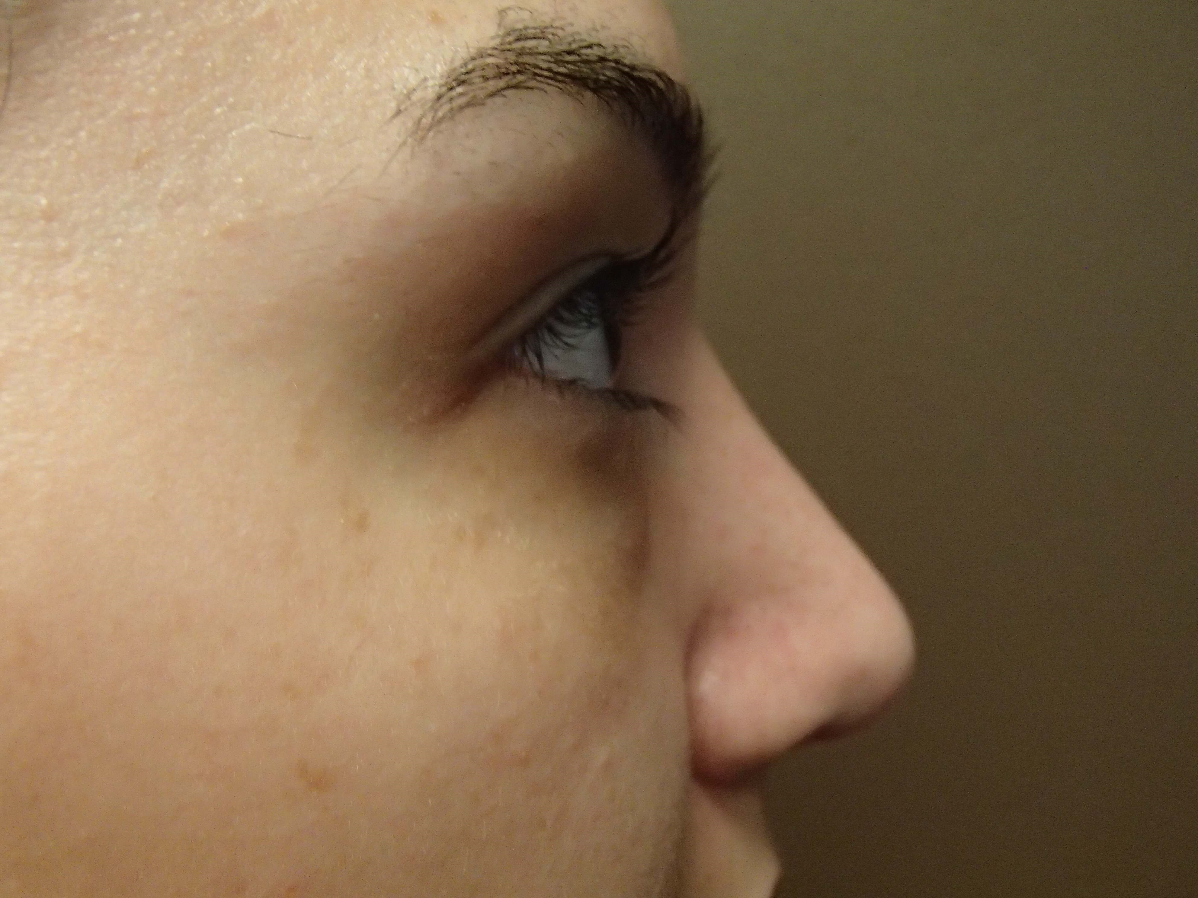 Rhinoplasty (nose job) After