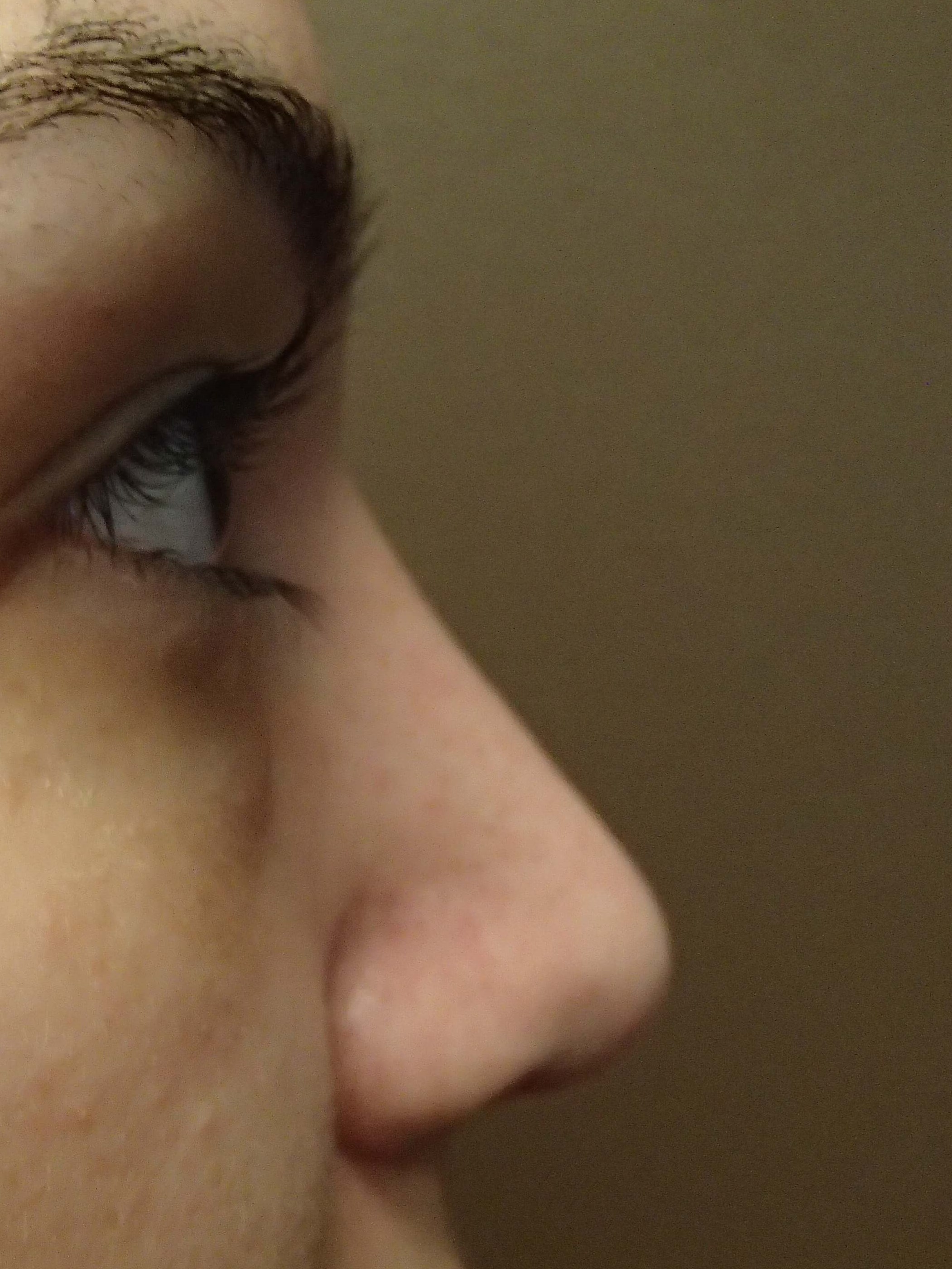Rhinoplasty (nose job) After
