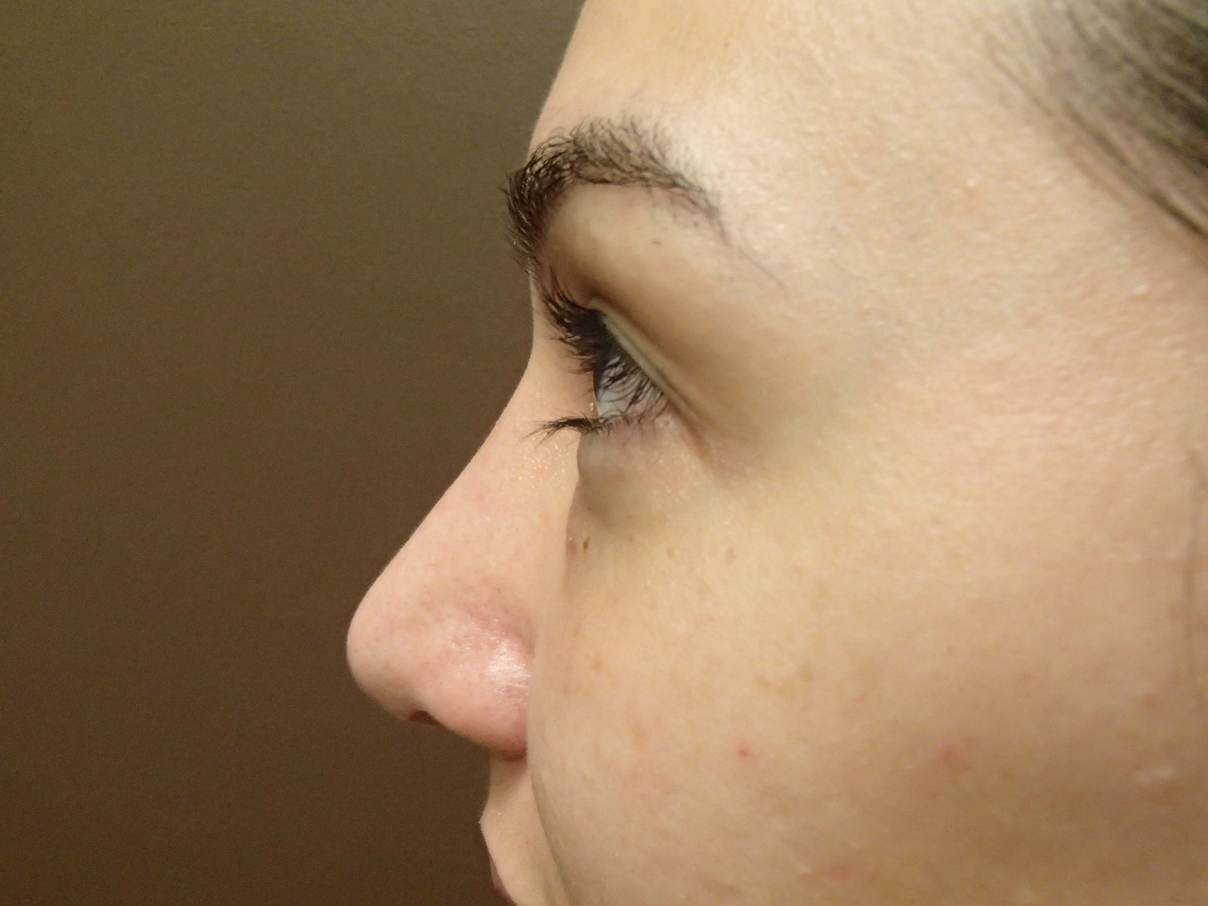 Rhinoplasty (nose job) After
