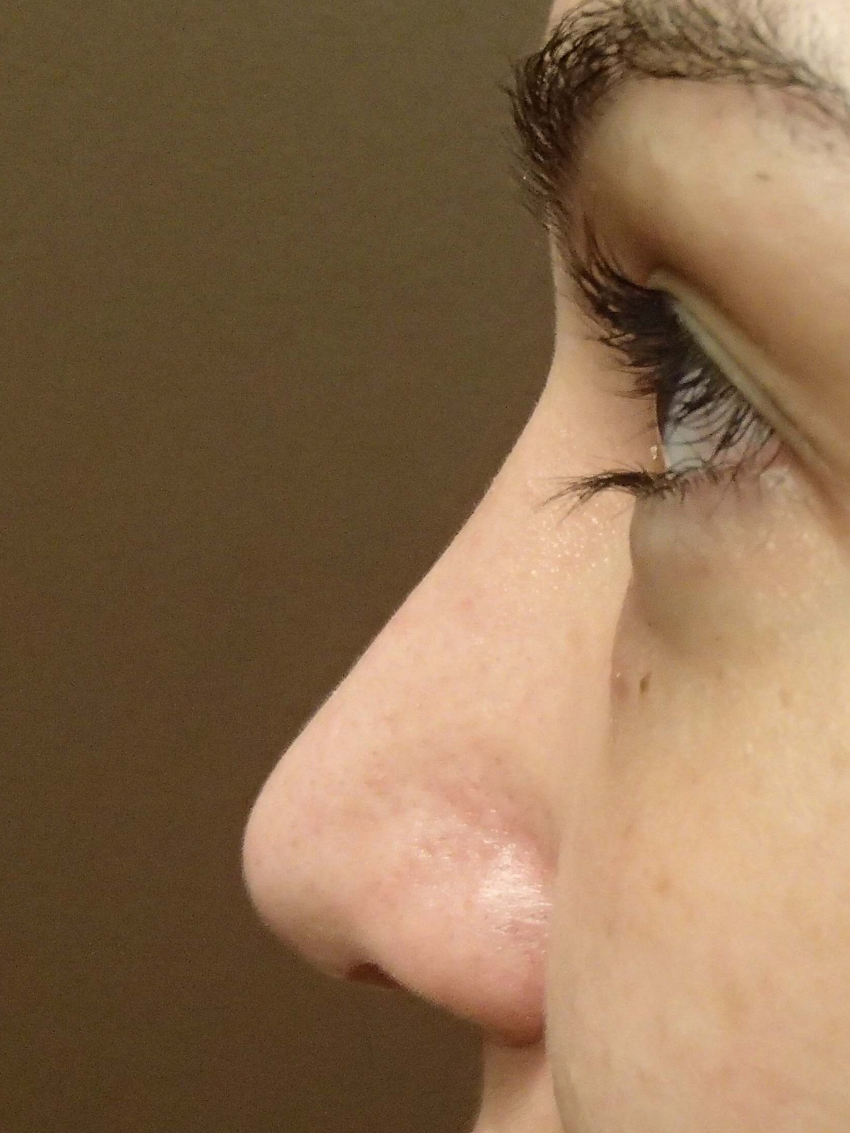 Rhinoplasty (nose job) After