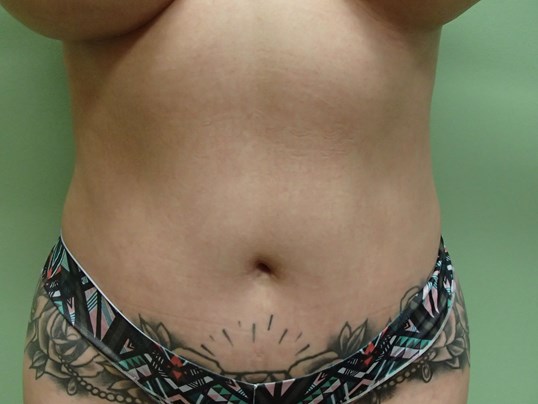 Liposuction Before