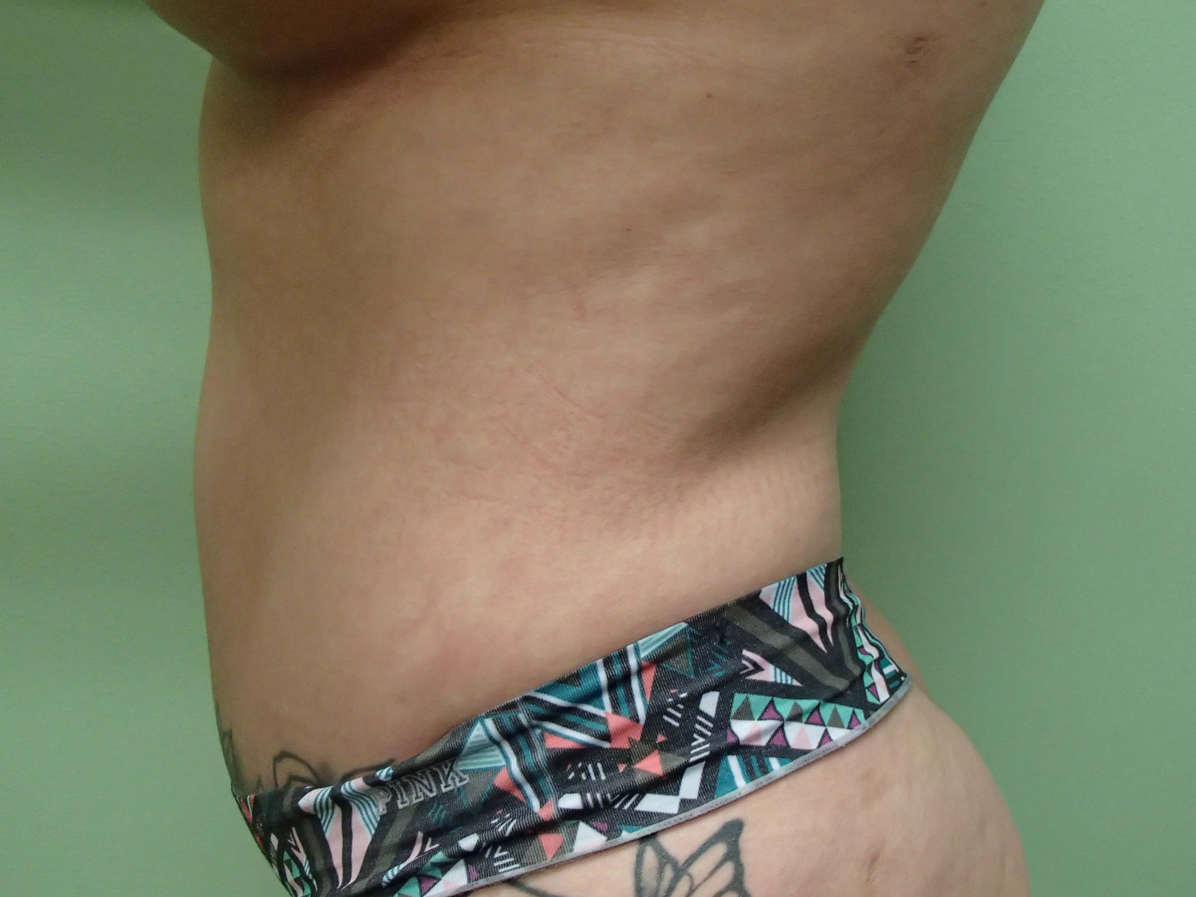 Liposuction Before