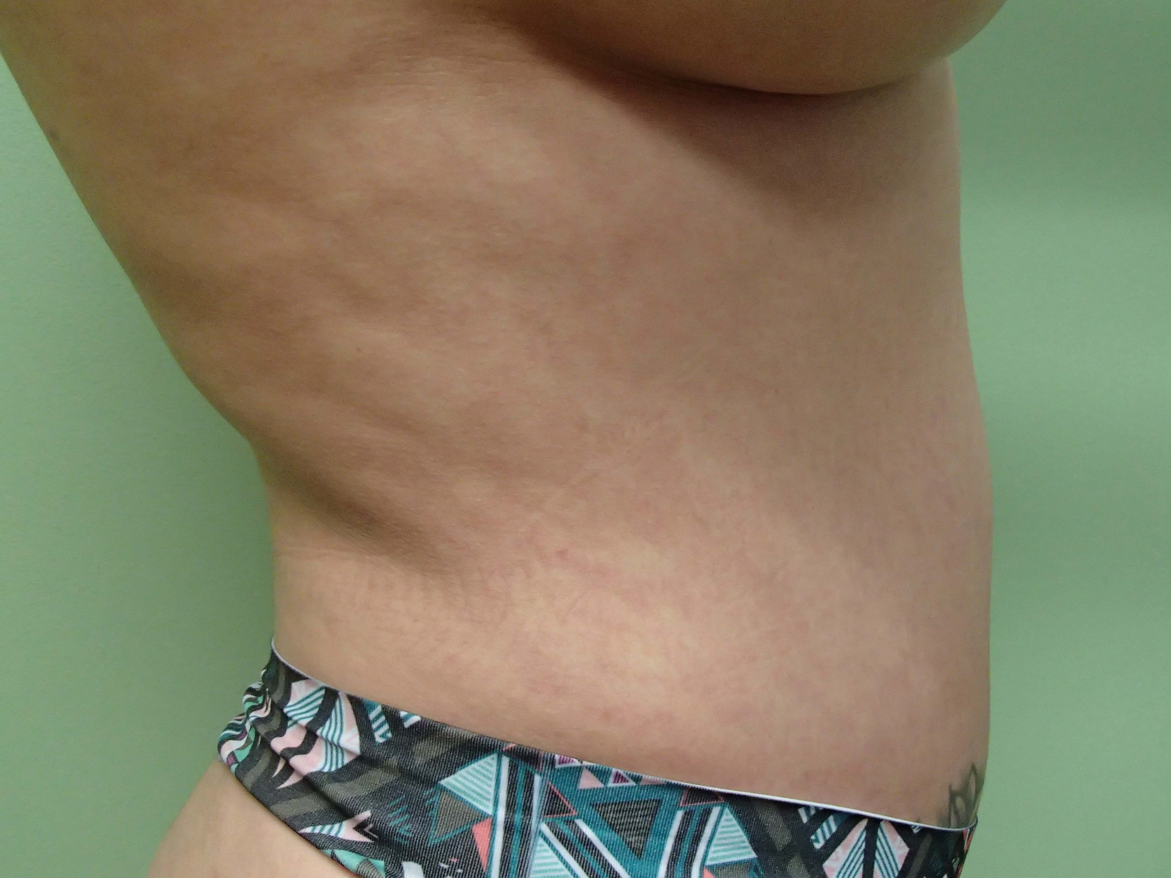 Liposuction Before