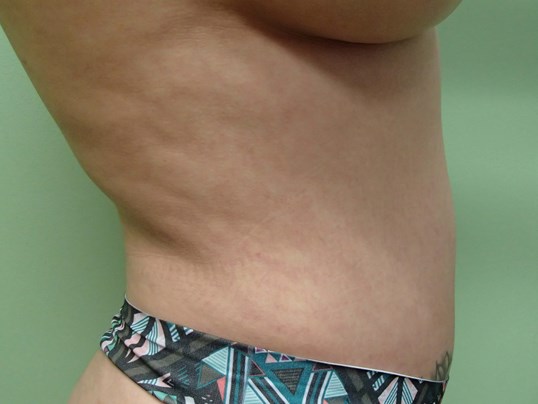Liposuction Before
