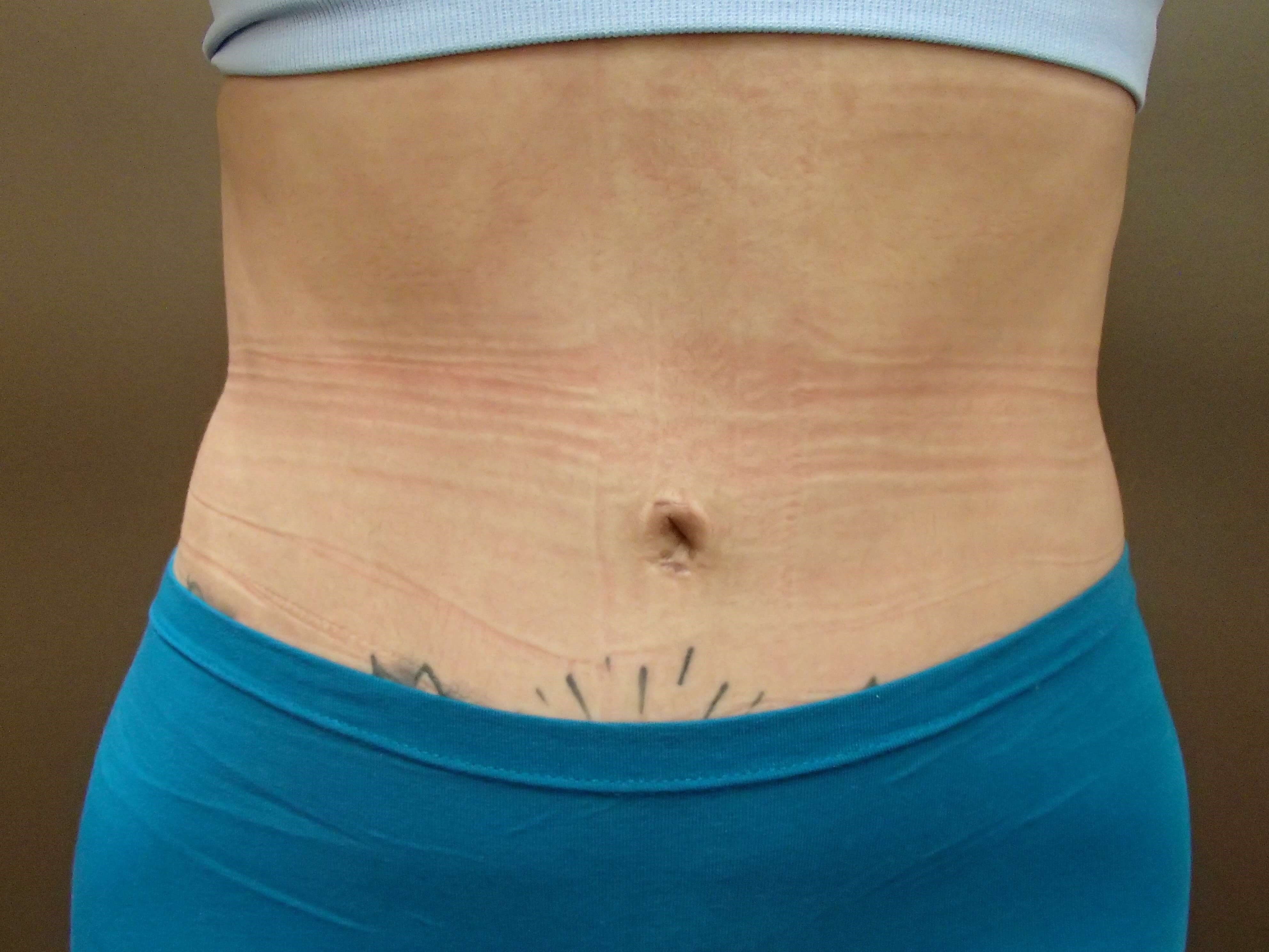 Liposuction After